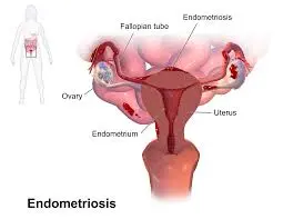 Specialized endometriosis treatment in Mumbai offering pain relief and fertility-preserving care